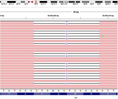 Metabolic pseudoprogression in a patient with metastatic KIT exon 11 GIST after 1 month of first-line imatinib: a case report